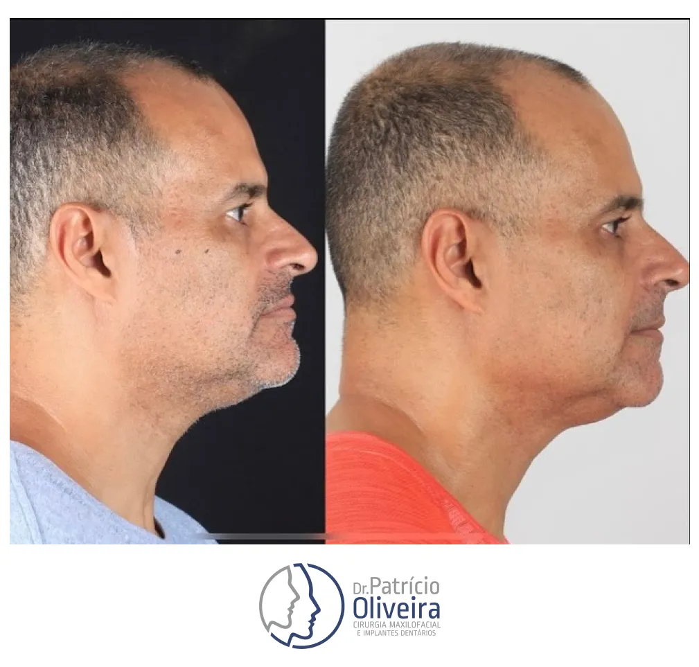 Antes e Depois - Paciente 01