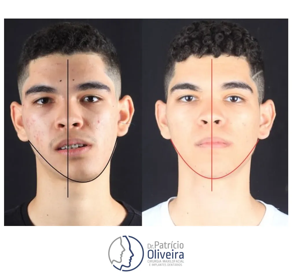 Antes e Depois - Paciente 02