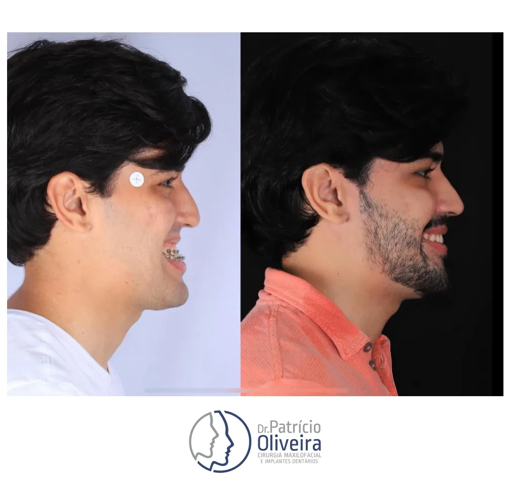 Antes e Depois - Paciente 03
