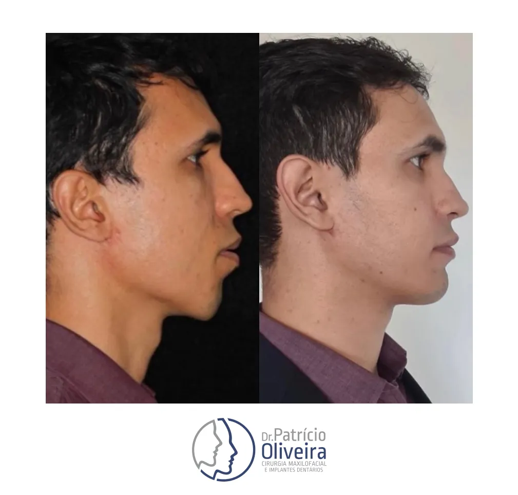 Antes e Depois - Paciente 04