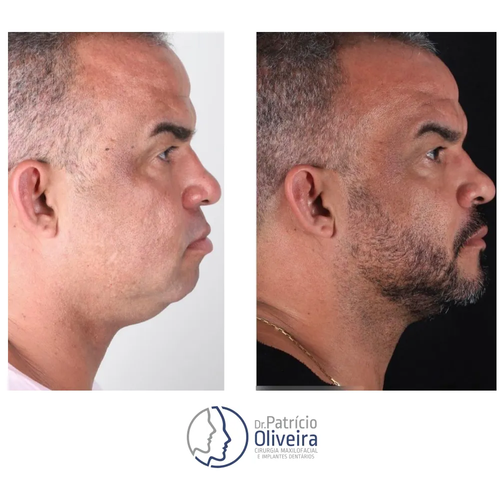 Antes e Depois - Paciente 05