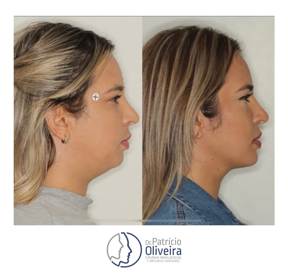 Antes e Depois - Paciente 06