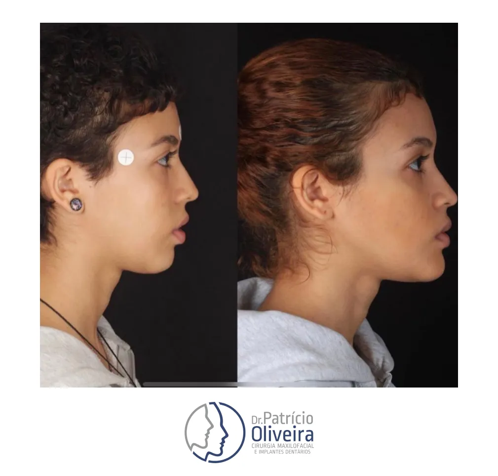 Antes e Depois - Paciente 08
