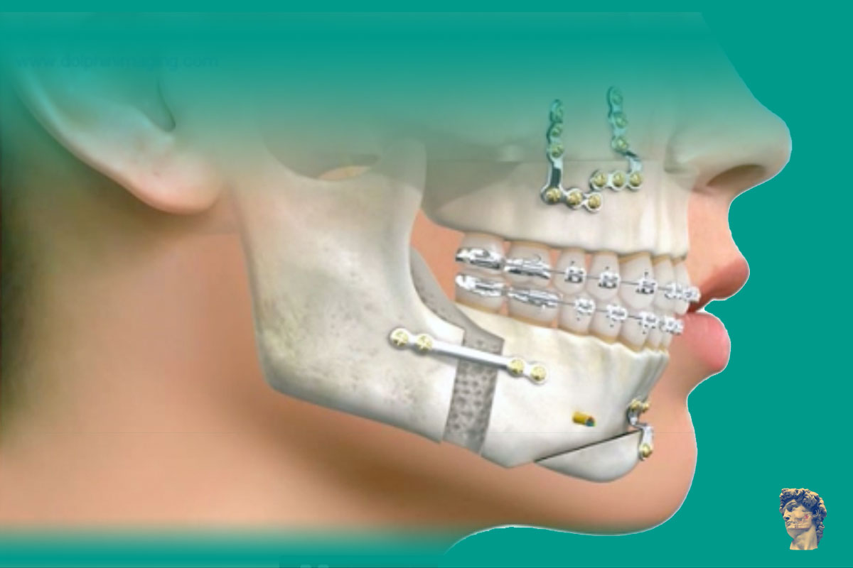 Cirurgia Ortognática para Correção de Desproporções Faciais