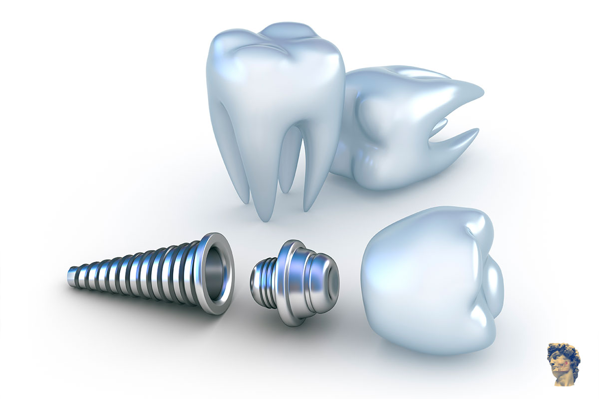 Implantes Dentários